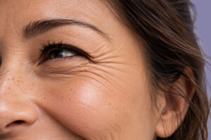 Botox for Crows Feet Temecula
