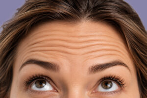 Botox for Forehead Lines Temecula