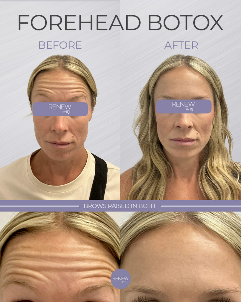 Botox for Forehead Temecula
