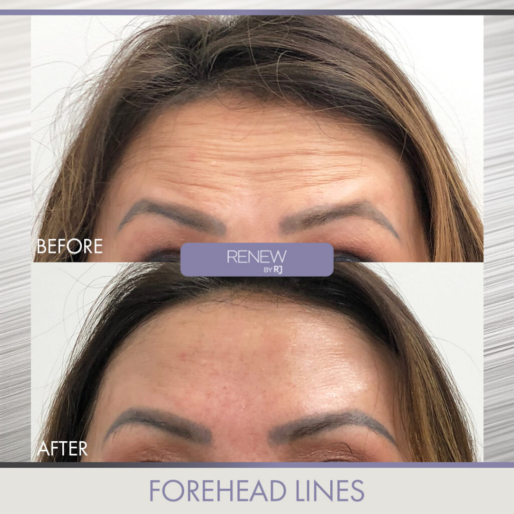 Forehead Lines Botox Renew by RJ Temecula