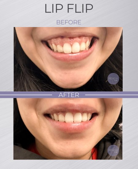 Lip Flip Botox Renew by RJ Temecula